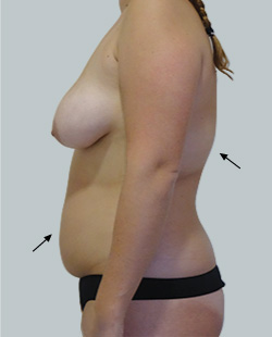 cs1_liposuction_face_before-img