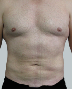 cs1_liposuction_Face_after-img