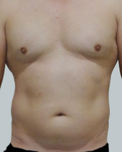 cs1_liposuction_face_before-img