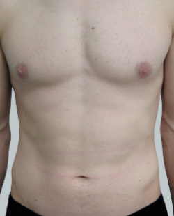 cs1_liposuction_Face_after-img