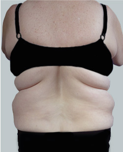 cs1_liposuction_face_before-img