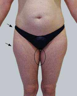 cs1_liposuction_face_before-img