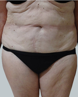 cs1_liposuction_Face_after-img