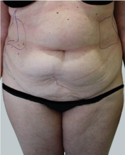 cs1_liposuction_face_before-img