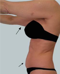 cs1_liposuction_face_before-img