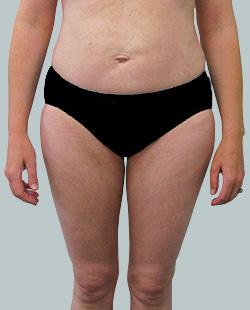 cs1_liposuction_Face_after-img