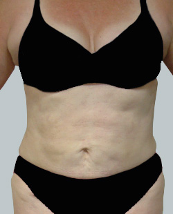 cs1_liposuction_Face_after-img