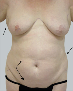 cs1_liposuction_face_before-img