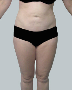 cs1_liposuction_Face_after-img