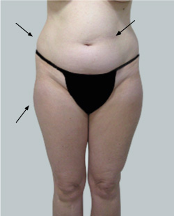 cs1_liposuction_face_before-img