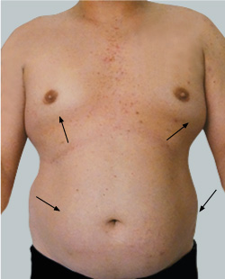 cs1_liposuction_face_before-img