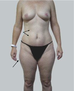 Tummy tuck with liposuction of the mons pubis, and a pubic lift 