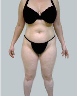 cs1_liposuction_face_before-img