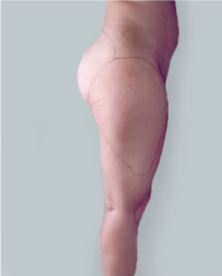 cs1_liposuction_face_before-img