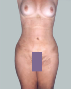 cs1_liposuction_Face_after-img