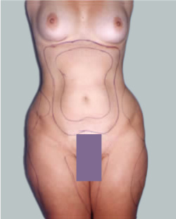 cs1_liposuction_face_before-img