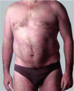 cs1_liposuction_face_before-img