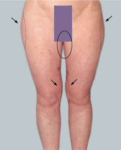 cs1_liposuction_face_before-img