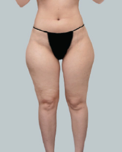 cs1_liposuction_face_before-img