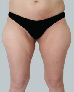 cs1_liposuction_face_before-img