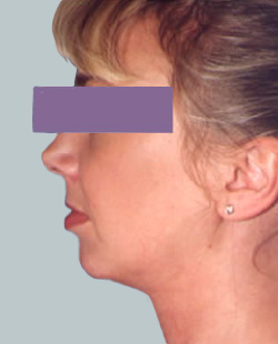 cs1_liposuction_Face_after-img