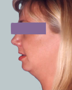 cs1_liposuction_face_before-img