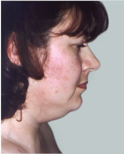 cs1_liposuction_face_before-img