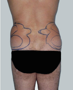 cs1_liposuction_face_before-img