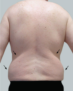 cs1_liposuction_face_before-img