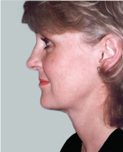 cs1_liposuction_Face_after-img