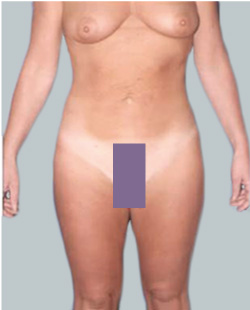 cs1_liposuction_Face_after-img