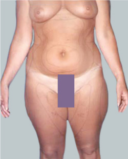 cs1_liposuction_face_before-img