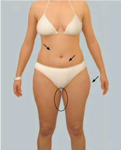 cs1_liposuction_face_before-img