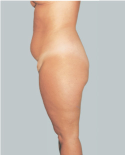 Liposuction Before + After - Expert Fat Removal Procedure