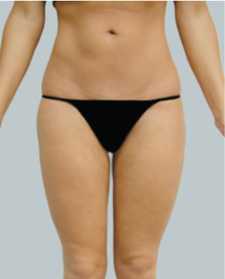 cs1_liposuction_Face_after-img