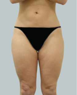 cs1_liposuction_face_before-img