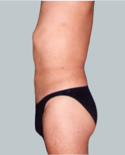 cs1_liposuction_Face_after-img