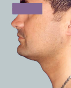 cs1_liposuction_Face_after-img