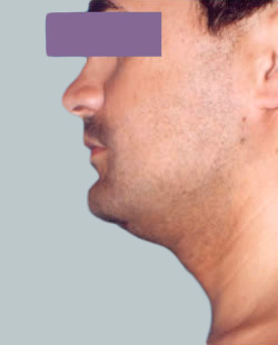 cs1_liposuction_face_before-img