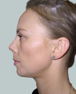 cs1_liposuction_Face_after-img