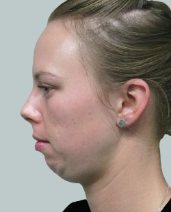 cs1_liposuction_face_before-img