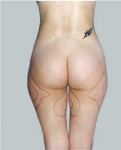 cs1_liposuction_face_before-img