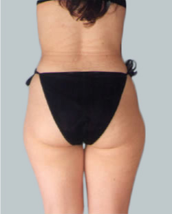 cs1_liposuction_face_before-img