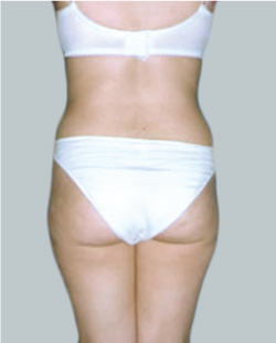 cs1_liposuction_Face_after-img