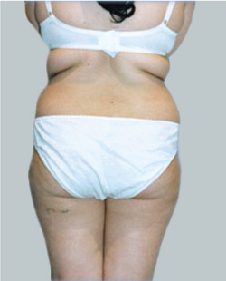 cs1_liposuction_face_before-img