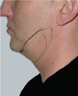 cs1_liposuction_face_before-img