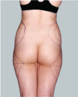 Pubic Lifts and Liposuction for Mons Rejuvenation - Explore Plastic Surgery