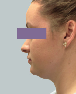 cs1_liposuction_face_before-img