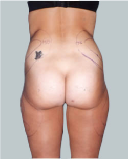 cs1_liposuction_face_before-img