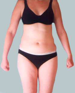 Liposuction Melbourne Procedures [2024 Before + After Pics]